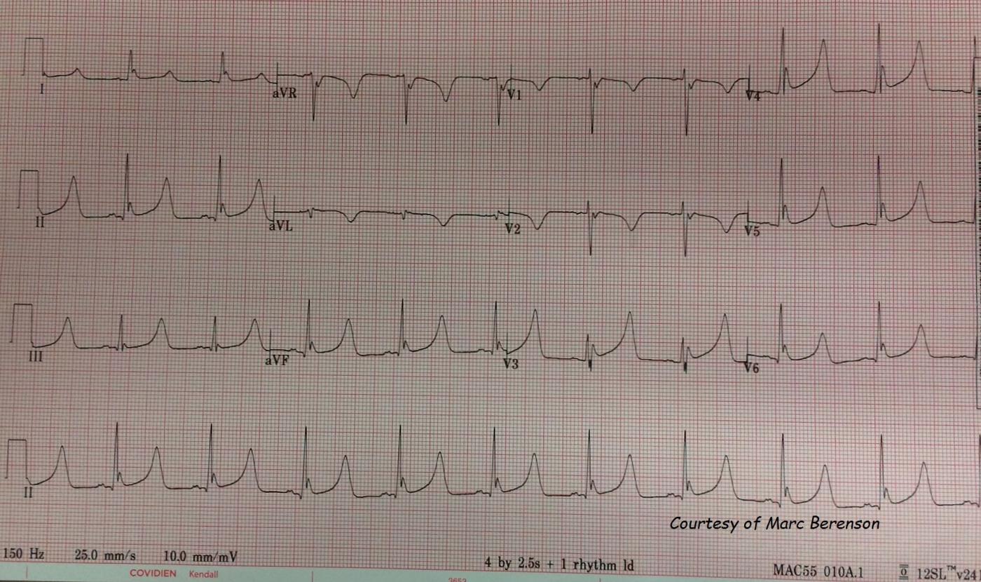 Osborn Waves Ecg Guru Instructor Resources